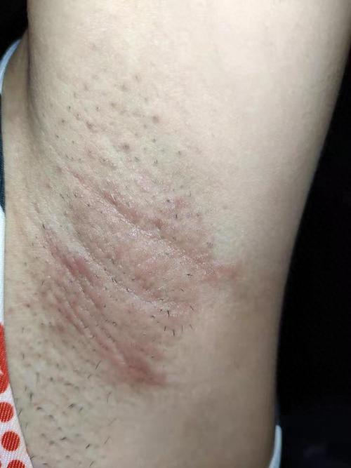 狐臭怎么彻底去除?