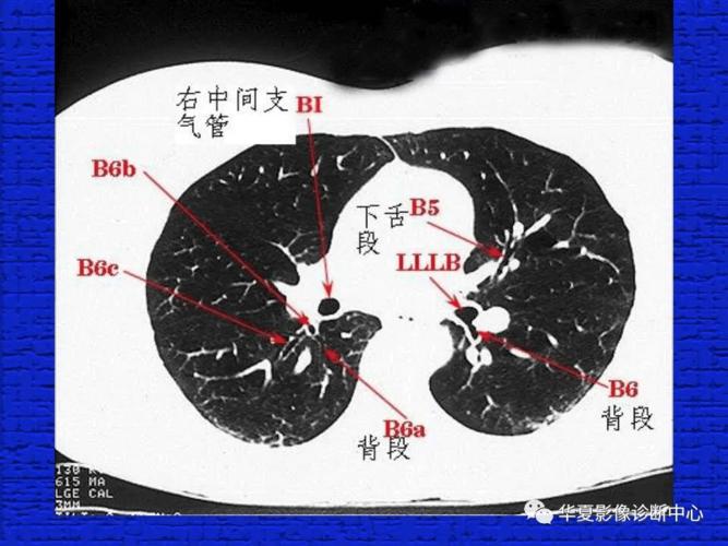 ct片子怎么看?
