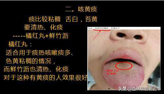 咳白痰是怎么回事?