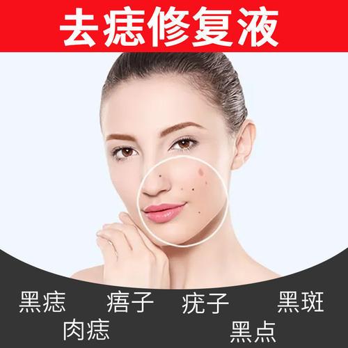 脸上的痣怎么去掉?
