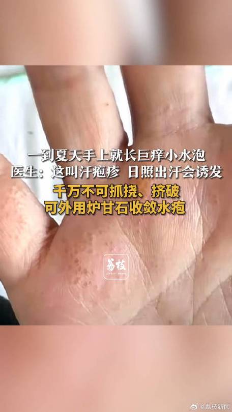 水泡怎么处理?