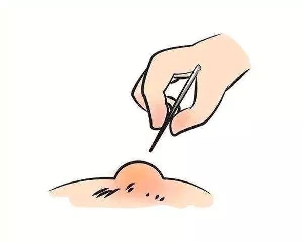 水泡怎么处理?